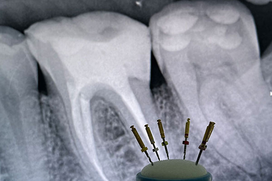 Endodoncia